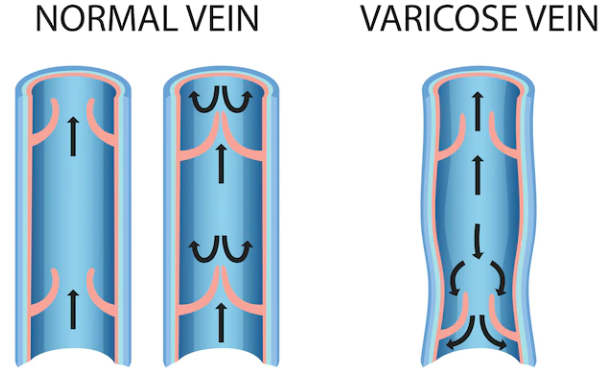 Posterior uveitis Posterior uveitis