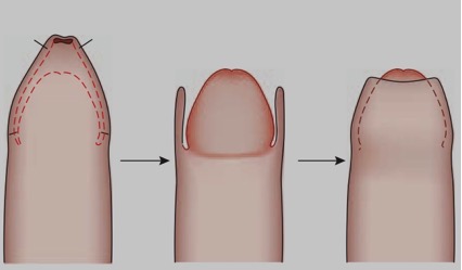 Partial Circumcision