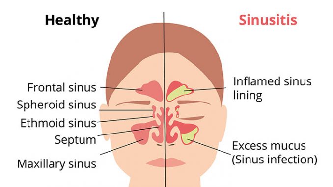 how long do sinus infections last 