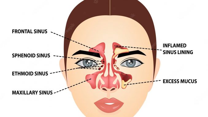 how to prevent sinus infections how to prevent sinus infections