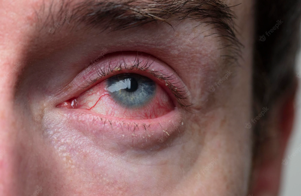 I Cured My Blepharitis Using Home Remedies! Here’s How I Did It
