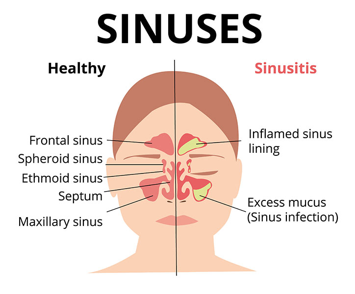 How Long Do Sinus Infections Last?